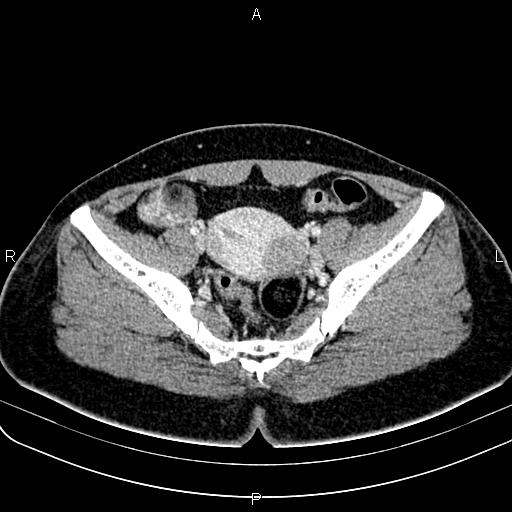 Bilateral ovarian teratoma (Radiopaedia 83131-97503 Axial With contrast 37).jpg