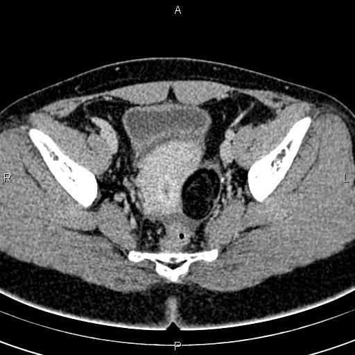 File:Bilateral ovarian teratoma (Radiopaedia 83131-97503 B 46).jpg