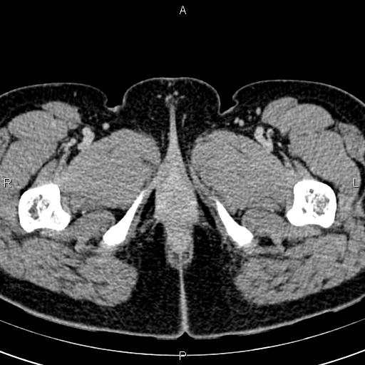 File:Bilateral ovarian teratoma (Radiopaedia 83131-97503 B 93).jpg