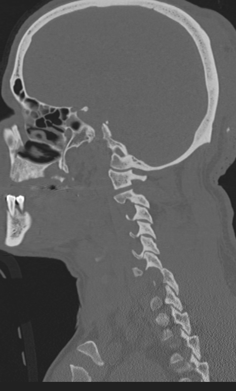 Bilateral perched facet joint (Radiopaedia 63149-71669 Sagittal bone window 5).jpg