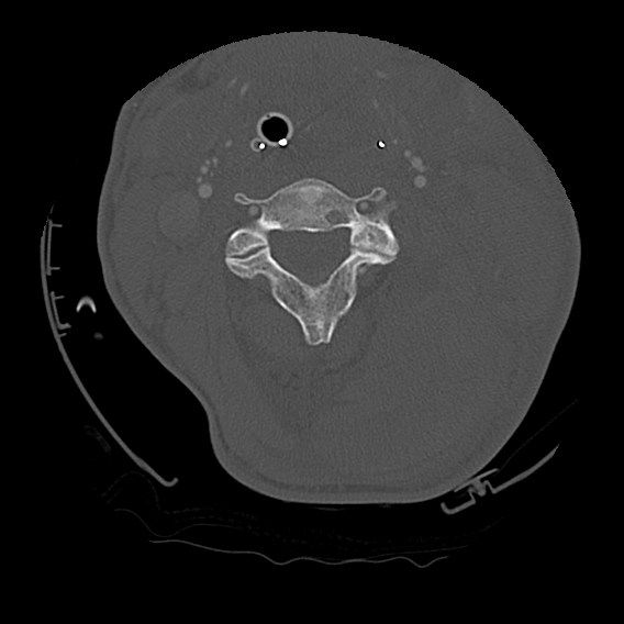 File:Bilateral perched facets with cord injury (Radiopaedia 45587-49713 Axial bone window 45).jpg