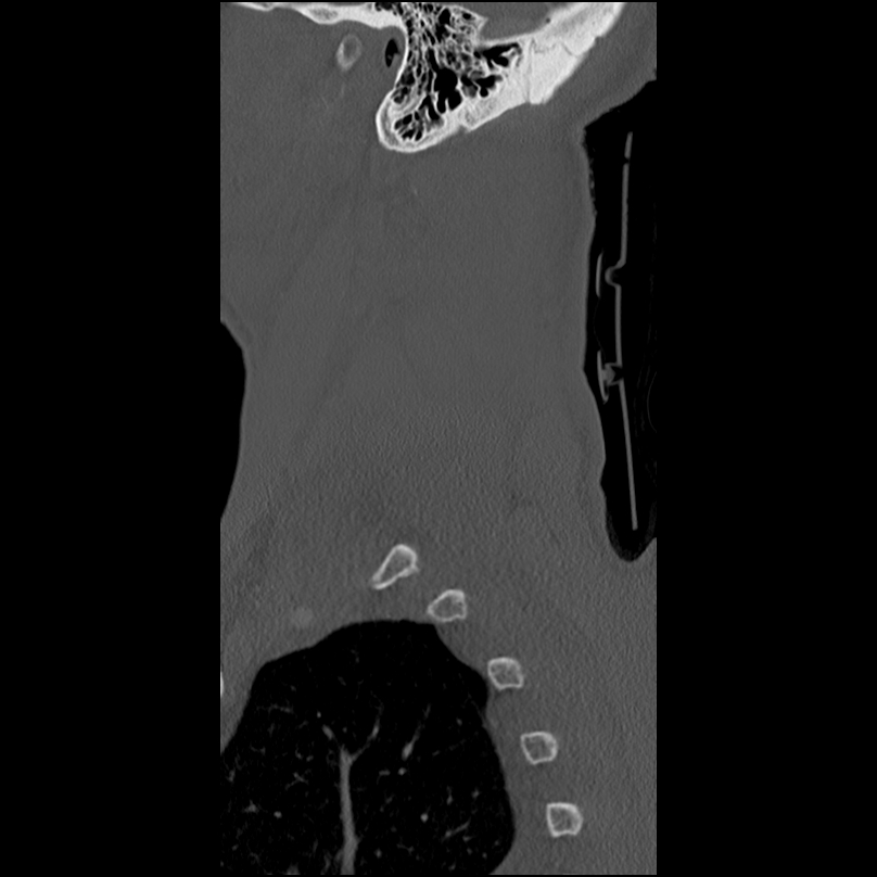 Bilateral perched facets with cord injury (Radiopaedia 45587-49713 Sagittal bone window 53).jpg