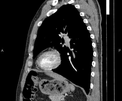 Bilateral pulmonary AVM (Radiopaedia 83134-97505 D 77).jpg