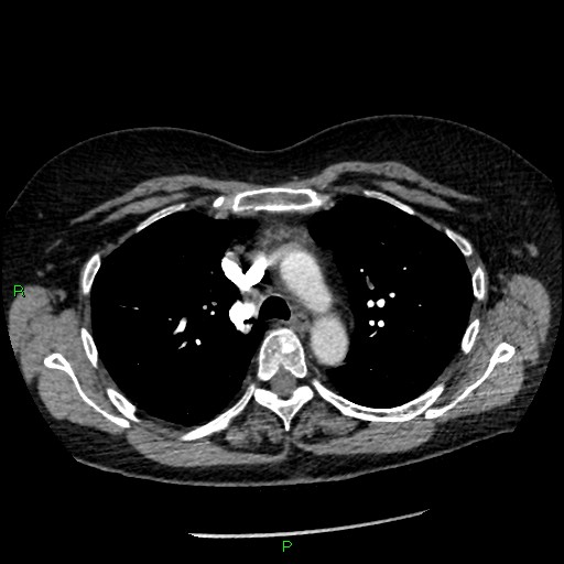 Bilateral pulmonary emboli (Radiopaedia 32700-33669 Axial C+ CTPA 36).jpg