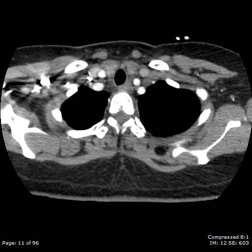 Bilateral pulmonary emboli with Hampton hump sign (Radiopaedia 54070-60246 Axial C+ CTPA 8).jpg