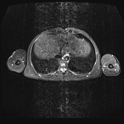 File:Bilateral spinoglenoid notch ganglion cysts (Radiopaedia 29577-30082 E 28).jpg