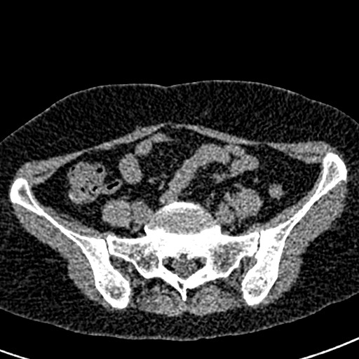 Bilateral staghorn calculi (Radiopaedia 59475-66842 Axial non-contrast 56).jpg