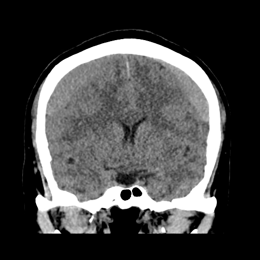 Bilateral subacute subdural hematoma (Radiopaedia 69240-79018 Coronal non-contrast 24).jpg