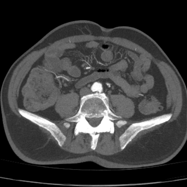 Bilateral superficial femoral arterial occlusion (Radiopaedia 25682-25857 A 15).jpg