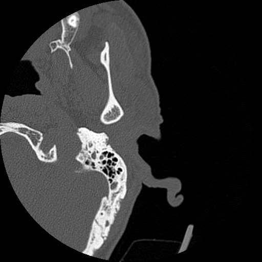 File:Bilateral temporal bone fractures (Radiopaedia 29482-29970 D 20).jpg