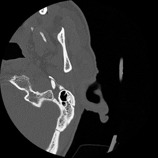 Bilateral temporal bone fractures (Radiopaedia 29482-29970 D 3).jpg