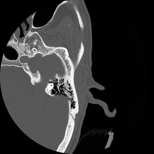 Bilateral temporal bone fractures (Radiopaedia 29482-29970 D 97).jpg