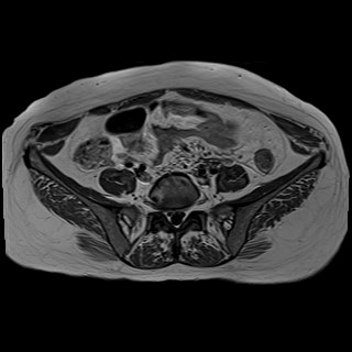 Bilateral tubo-ovarian abscesses (Radiopaedia 58635-65829 Axial T1 C+ 6).jpg