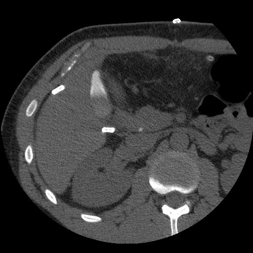 File:Bile leak from liver traumatic laceration (Radiopaedia 63463-72077 Axial Biliscopin 55).jpg