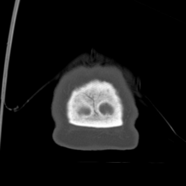 Biparietal osteodystrophy (Radiopaedia 46109-50463 Coronal bone window 105).jpg