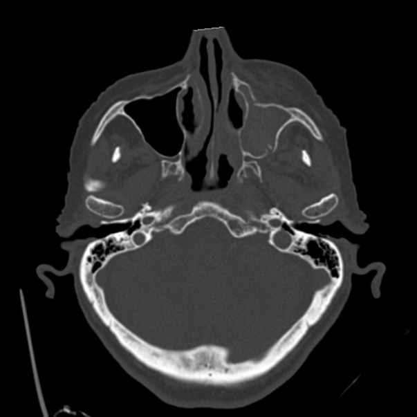 Biparietal osteodystrophy (Radiopaedia 46109-50463 bone window 16).jpg