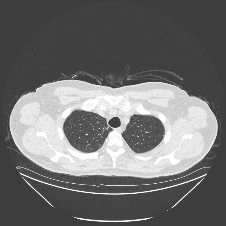 Birt-Hogg-Dubé syndrome (Radiopaedia 52578-58491 Axial lung window 10).jpg