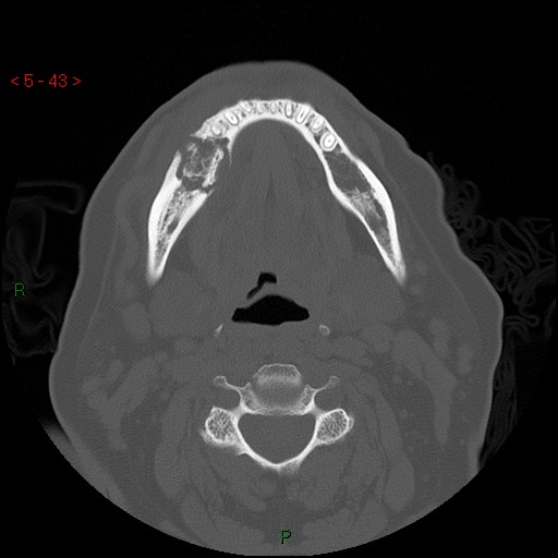 Bisphosphonate-related osteonecrosis of the jaw (Radiopaedia 54147-60329 Axial bone window 37).jpg