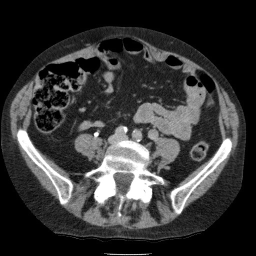 Bladder tumor detected on trauma CT (Radiopaedia 51809-57609 C 88).jpg