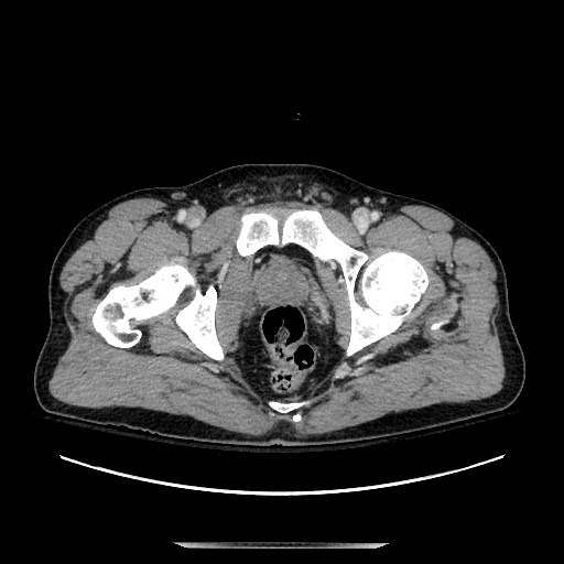 Blunt abdominal trauma with solid organ and musculoskelatal injury with active extravasation (Radiopaedia 68364-77895 A 152).jpg