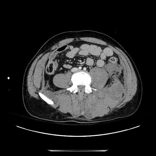 Blunt abdominal trauma with solid organ and musculoskelatal injury with active extravasation (Radiopaedia 68364-77895 A 94).jpg