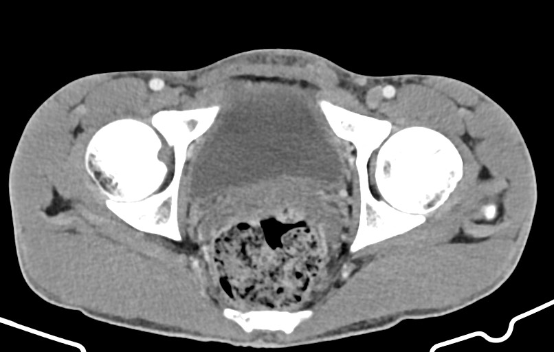 Blunt injury to the small bowel (Radiopaedia 74953-85987 A 183).jpg