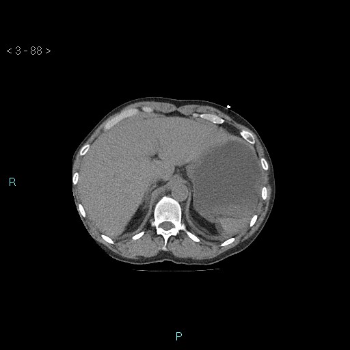 File:Boerhaave syndrome (Radiopaedia 27683-27897 Axial non-contrast 88).jpg