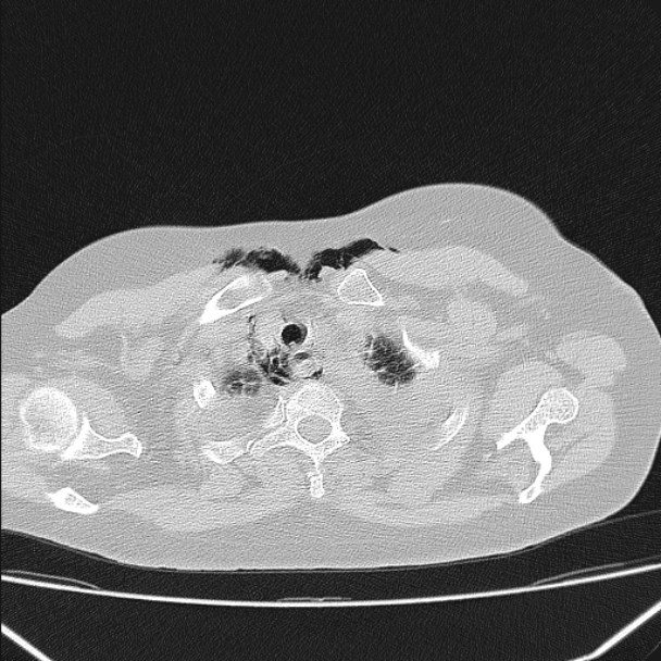 Boerhaave syndrome (Radiopaedia 45644-49799 Axial lung window 32).jpg