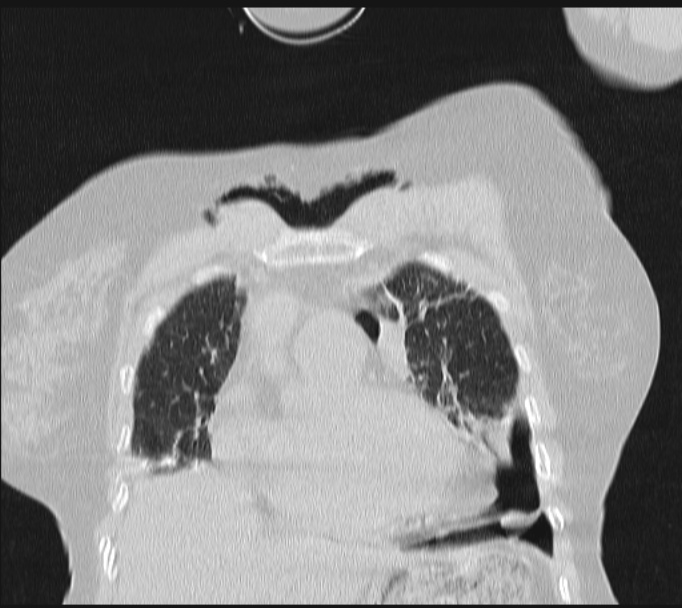 Boerhaave syndrome (Radiopaedia 45644-49799 Coronal lung window 19).jpg