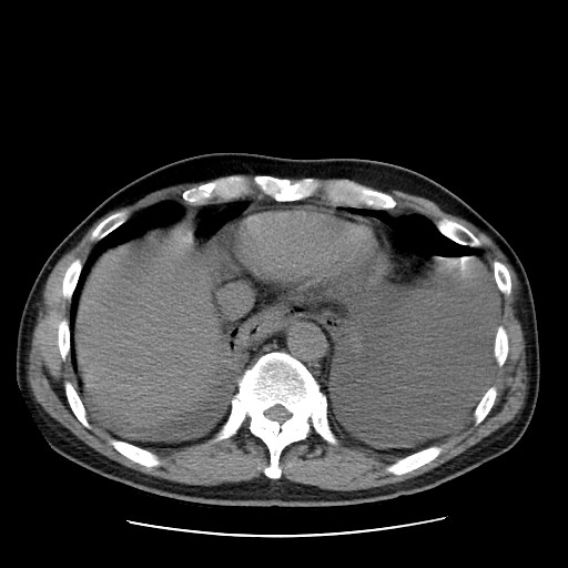 Boerhaave syndrome (Radiopaedia 59796-67310 Axial liver window 50).jpg