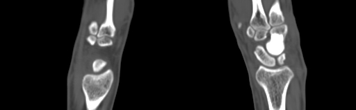 Bone islands - carpus (Radiopaedia 63141-71658 Coronal bone window 25).jpg