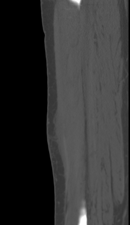 Bone metastasis - tibia (Radiopaedia 57665-64609 Sagittal bone window 124).jpg