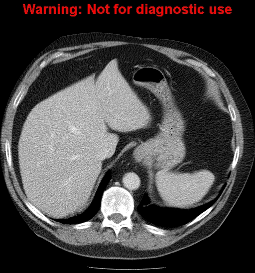 File:Bosniak renal cyst - type IV (Radiopaedia 23402-23466 D 11).jpg
