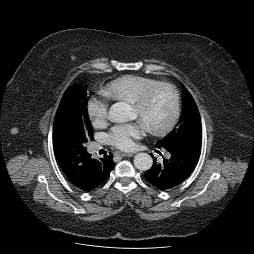 Bovine aortic arch - right internal mammary vein drains into the superior vena cava (Radiopaedia 63296-71875 A 79).jpg