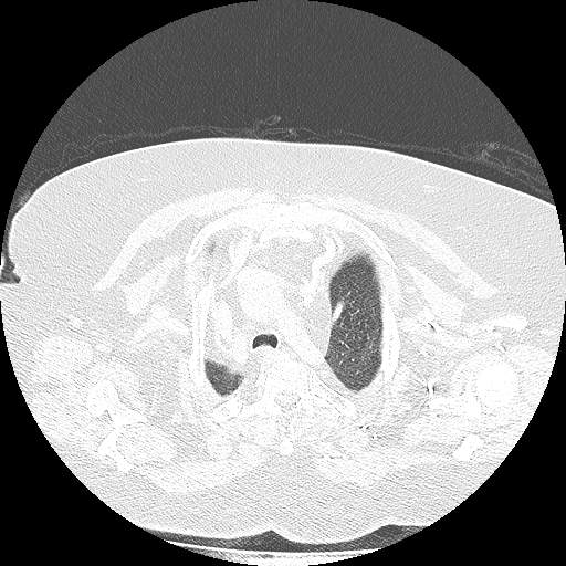 Bovine aortic arch - right internal mammary vein drains into the superior vena cava (Radiopaedia 63296-71875 Axial lung window 25).jpg