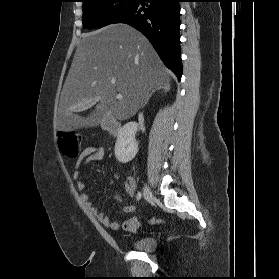 File:Bowel and splenic infarcts in acute lymphocytic leukemia (Radiopaedia 61055-68913 C 48).jpg
