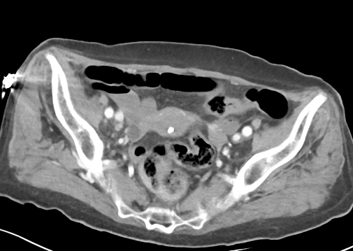 File:Bowel ischemia (Radiopaedia 58273-65382 A 52).png