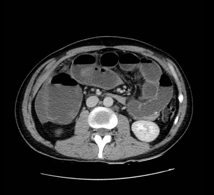 Bowel obstruction from colon carcinoma (Radiopaedia 22995-23028 A 39).jpg