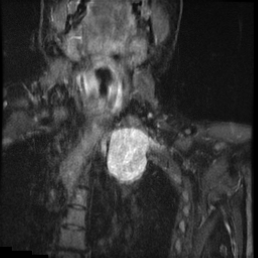 File:Brachial plexus neurofibroma (Radiopaedia 28030-28291 Coronal STIR 10).png
