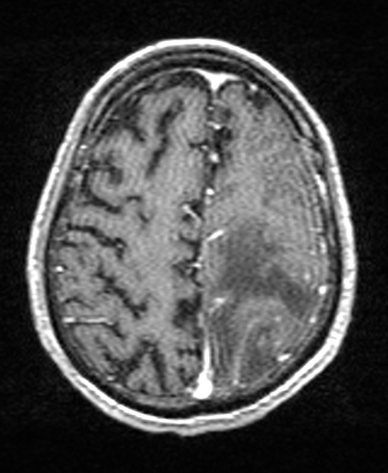 Brain abscess with dual rim sign (Radiopaedia 87566-103938 Axial T1 C+ 124).jpg