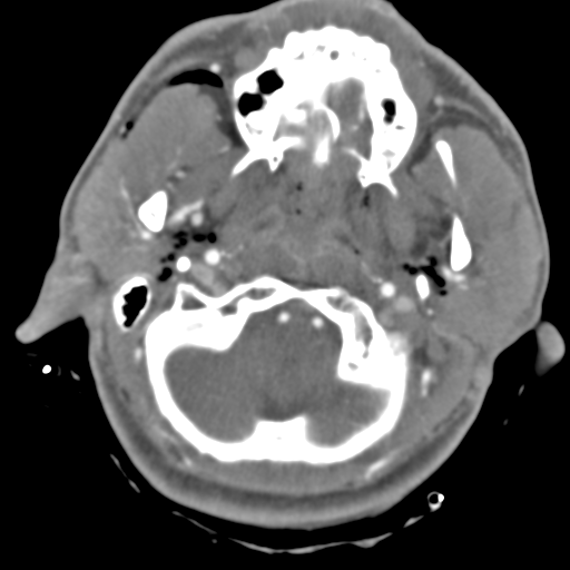 File:Brain contusions, internal carotid artery dissection and base of skull fracture (Radiopaedia 34089-35339 D 50).png