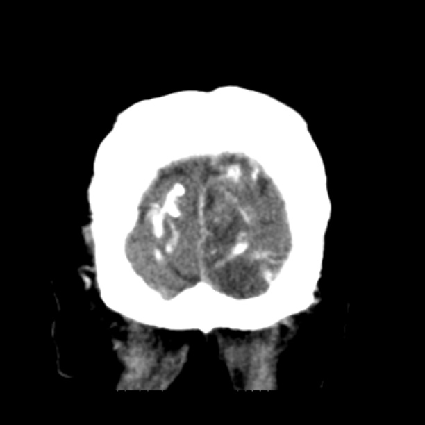 Brain cortical laminar necrosis (Radiopaedia 25822-25971 C 51).jpg