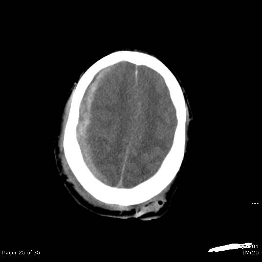 File:Brain death after motor vehicle collision (Radiopaedia 88470-105114 Axial non-contrast 25).jpg