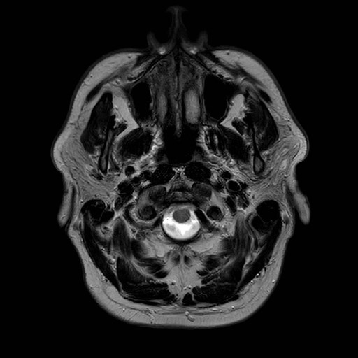 File:Brain metastases from lung cancer (Radiopaedia 83839-99028 Axial T2 2).jpg