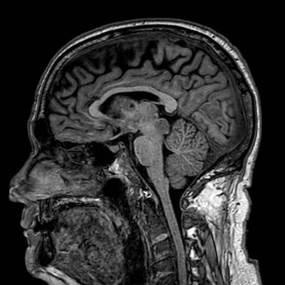 Brain metastases from lung cancer (Radiopaedia 83839-99028 Sagittal T1 62).jpg
