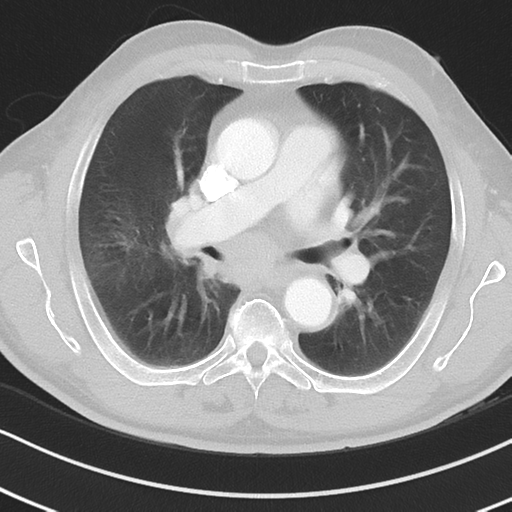 Brain metastasis (large cystic mass) (Radiopaedia 47497-52104 Axial lung window 21).png