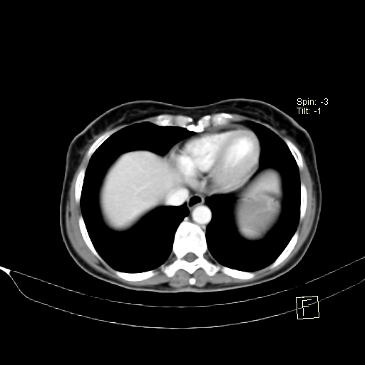 Brain metastasis as initial presentation of non-small cell lung cancer (Radiopaedia 65122-74127 A 37).jpg