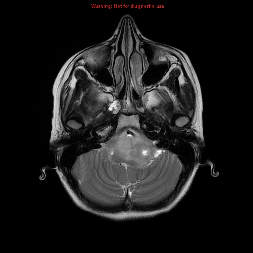 File:Brainstem glioma (Radiopaedia 9444-10124 Axial T2 4).jpg