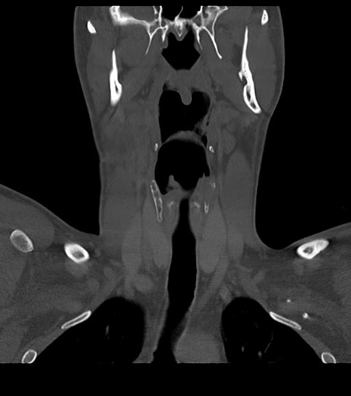 File:Branchial cleft cyst (Radiopaedia 31167-31875 Coronal bone window 31).jpg