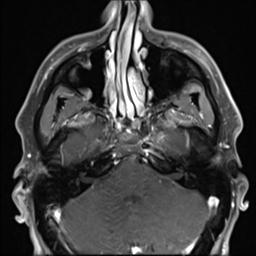 File:Branchial cleft cyst (Radiopaedia 31167-31876 Axial T1 C+ fat sat 30).jpg